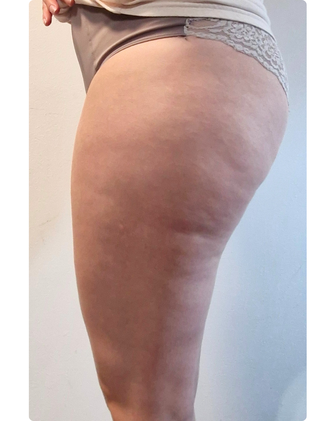 Antes y después celulitis Kit Reafirma 24/7