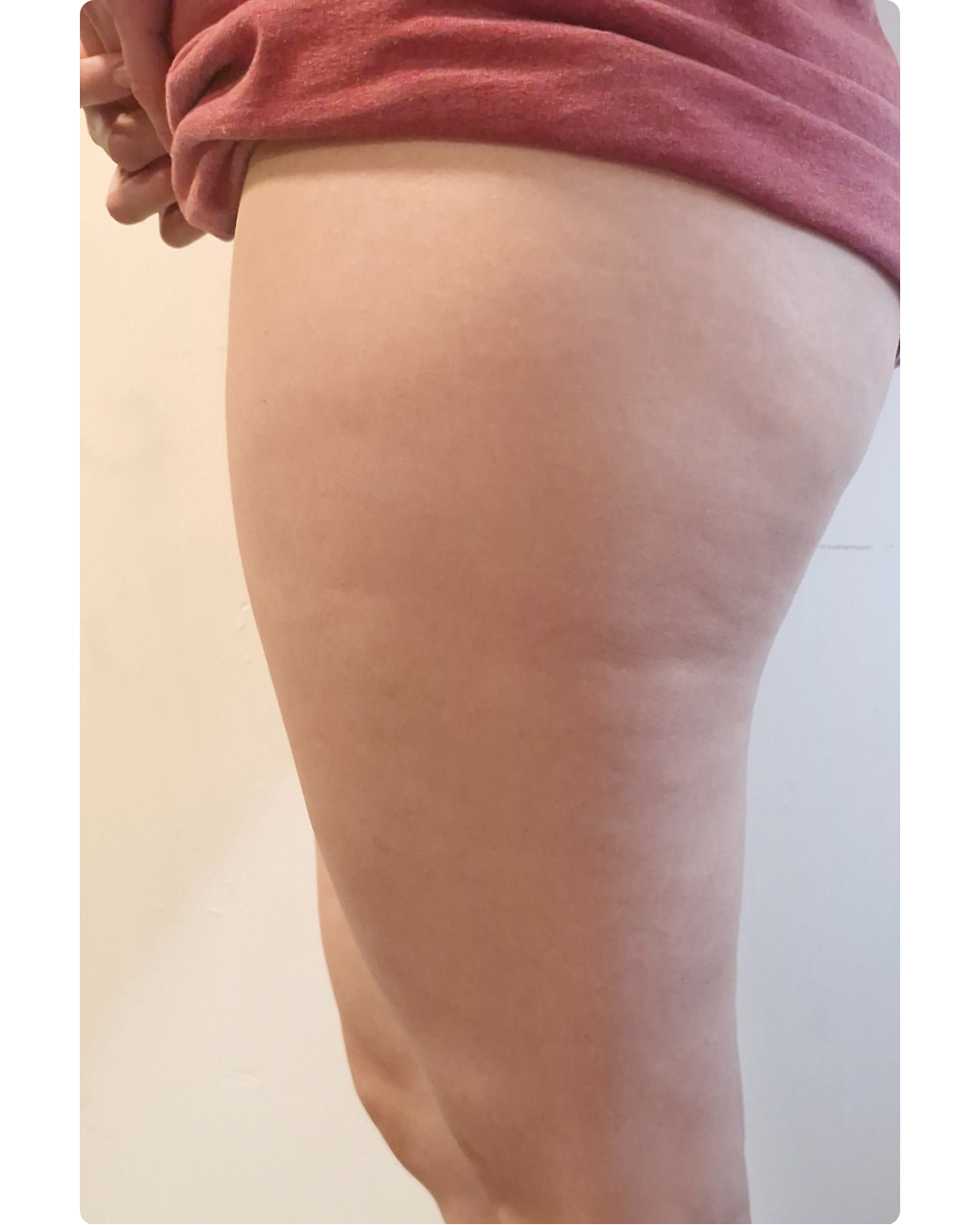 Antes y después celulitis Kit Reafirma 24/7 resultado 2